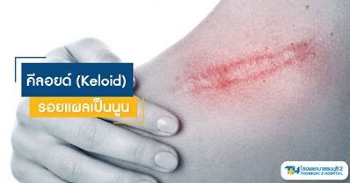 คีลอยด์ (Keloid) | Dek-D.com