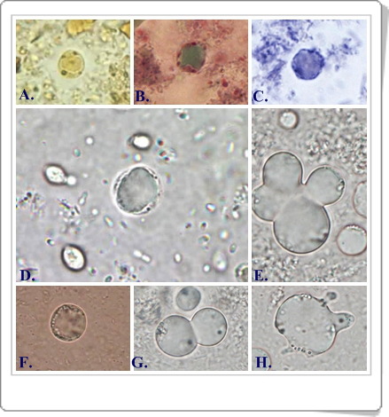 Бластоциста у ребенка. Blastocystis Hominis микроскоп. Бластоцисты хоминис. Цисты бластоцисты хоминис. Бластоциста хоминис в Кале.